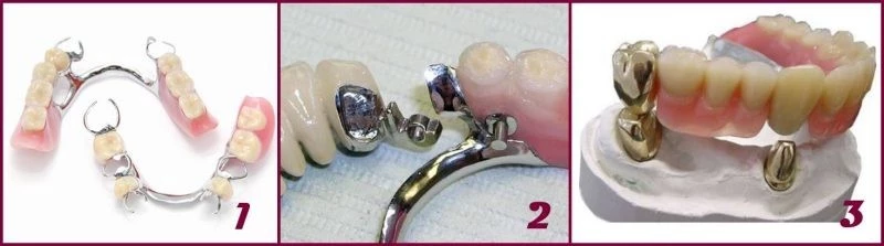 Бюгельный протез