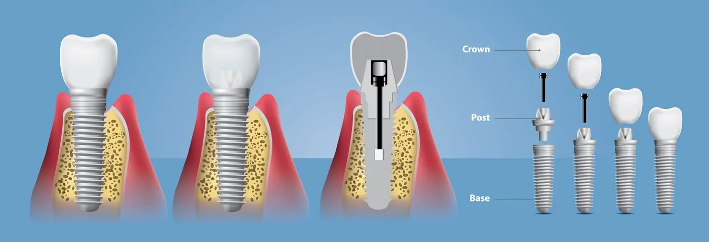 Немедленная нагрузка на имплантат (установка временной коронки)