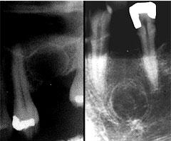 Резидуальная киста зуба Резидуальная киста зуба
