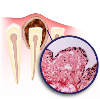 фолликулярная киста зуба фолликулярная киста зуба