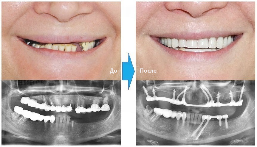Базальная имплантация до и после