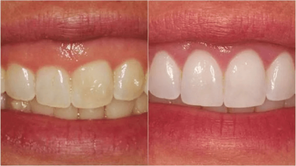 Коррекция десневого контура