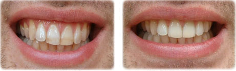 Художественная реставрация зубов