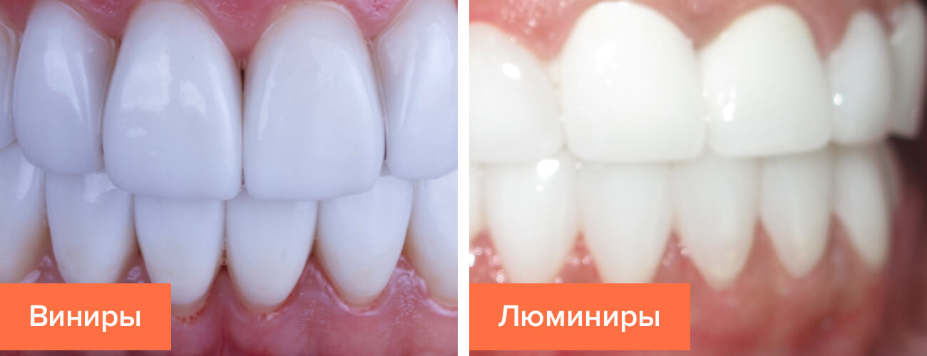 Виниры и люминиры