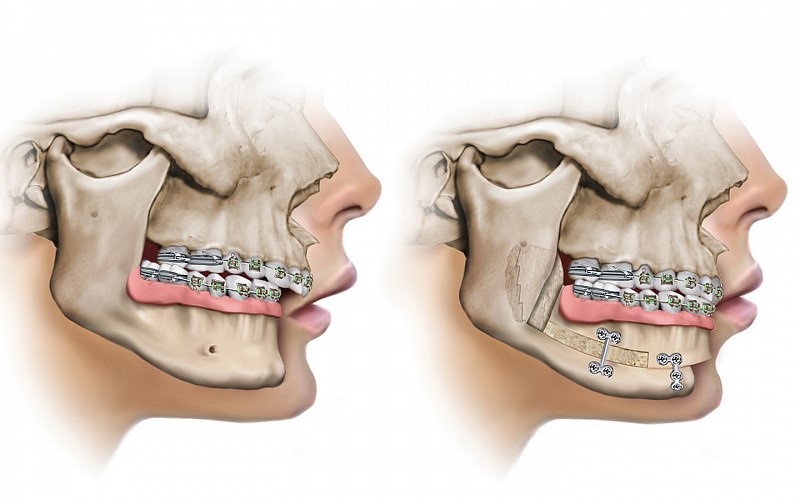 Хирургическая коррекция прикуса