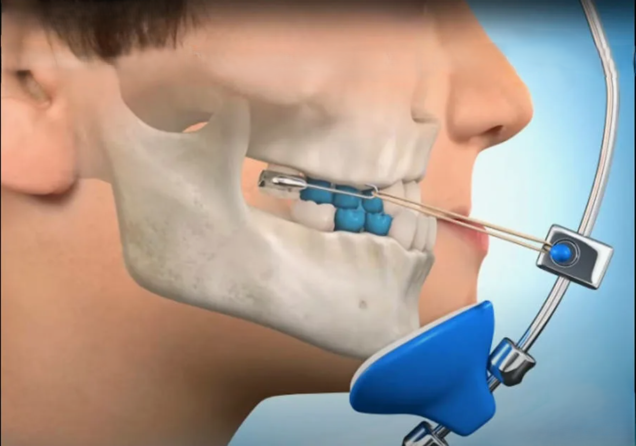 Функциональная терапия