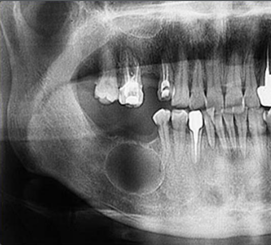 кератокиста кератокиста