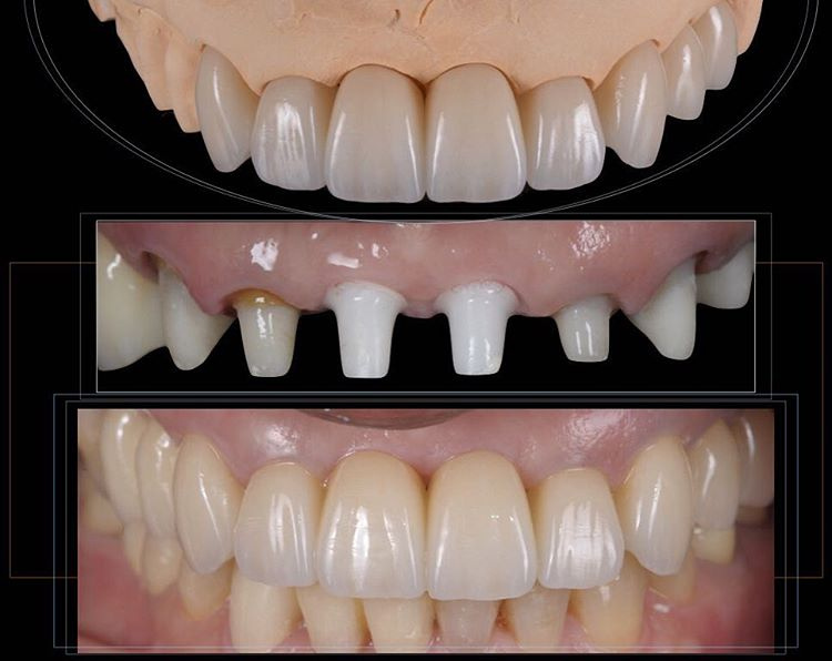 Зубные коронки обычные