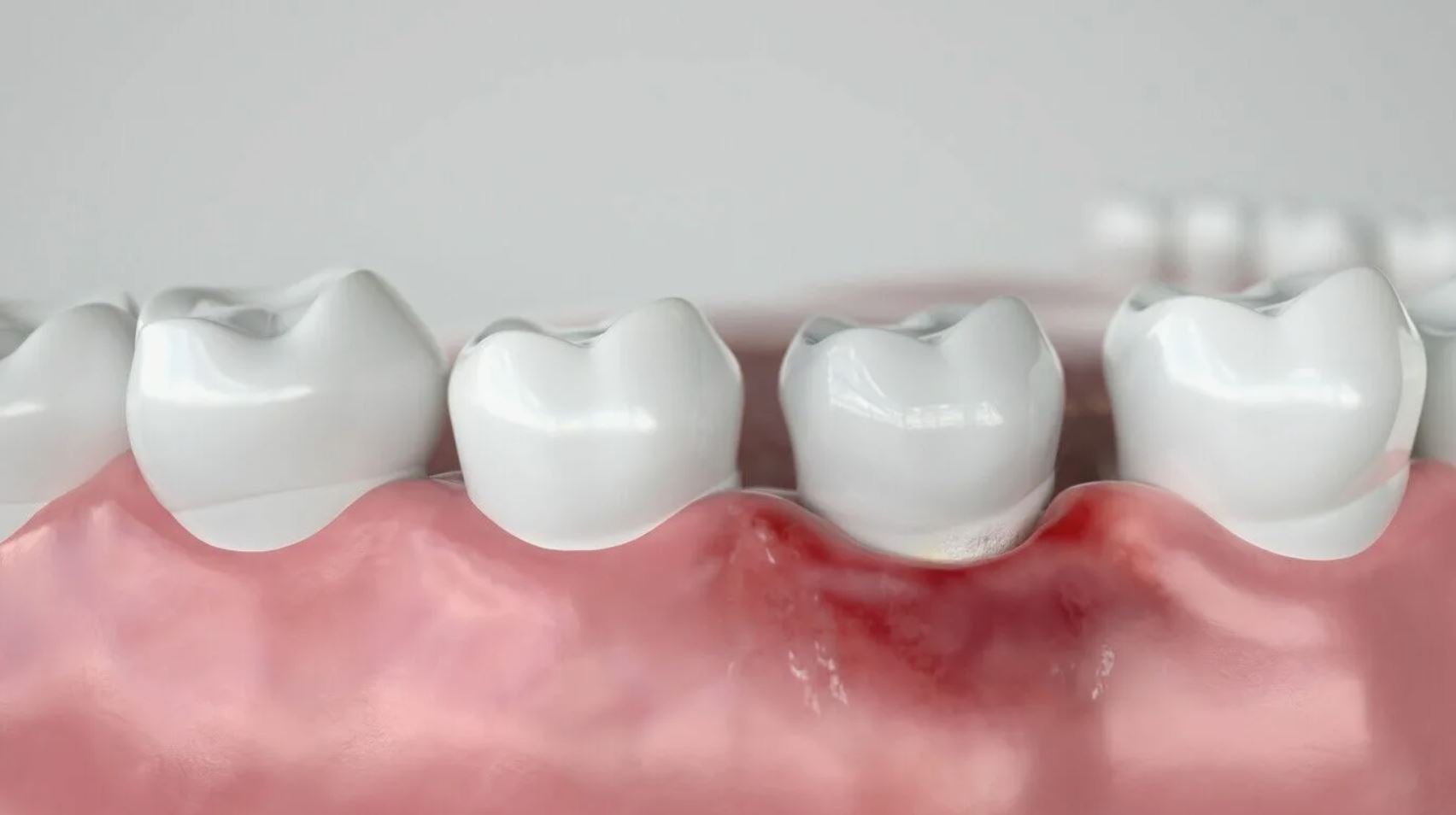 Лечение гингивита