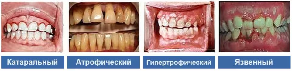 Какой бывает гингивит? Классификация