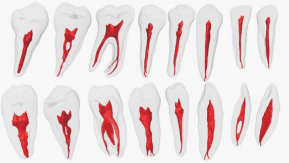 Форма каналов зубов нижней челюсти