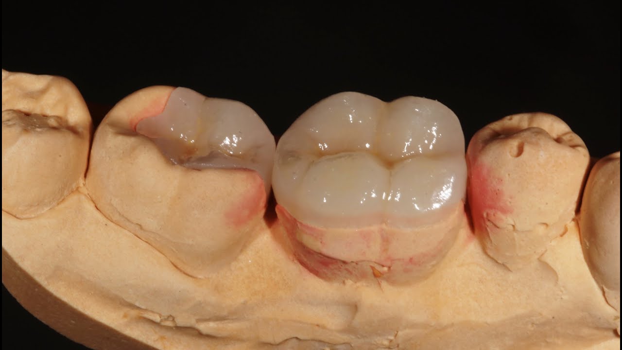 Микропротезирование зубов