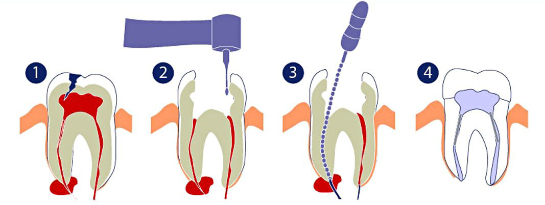 лечение кисты зуба