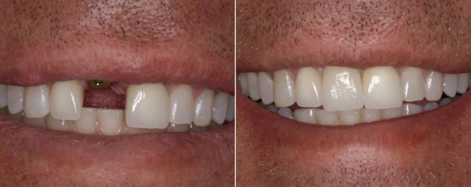 Имплантация одного зуба - до и после