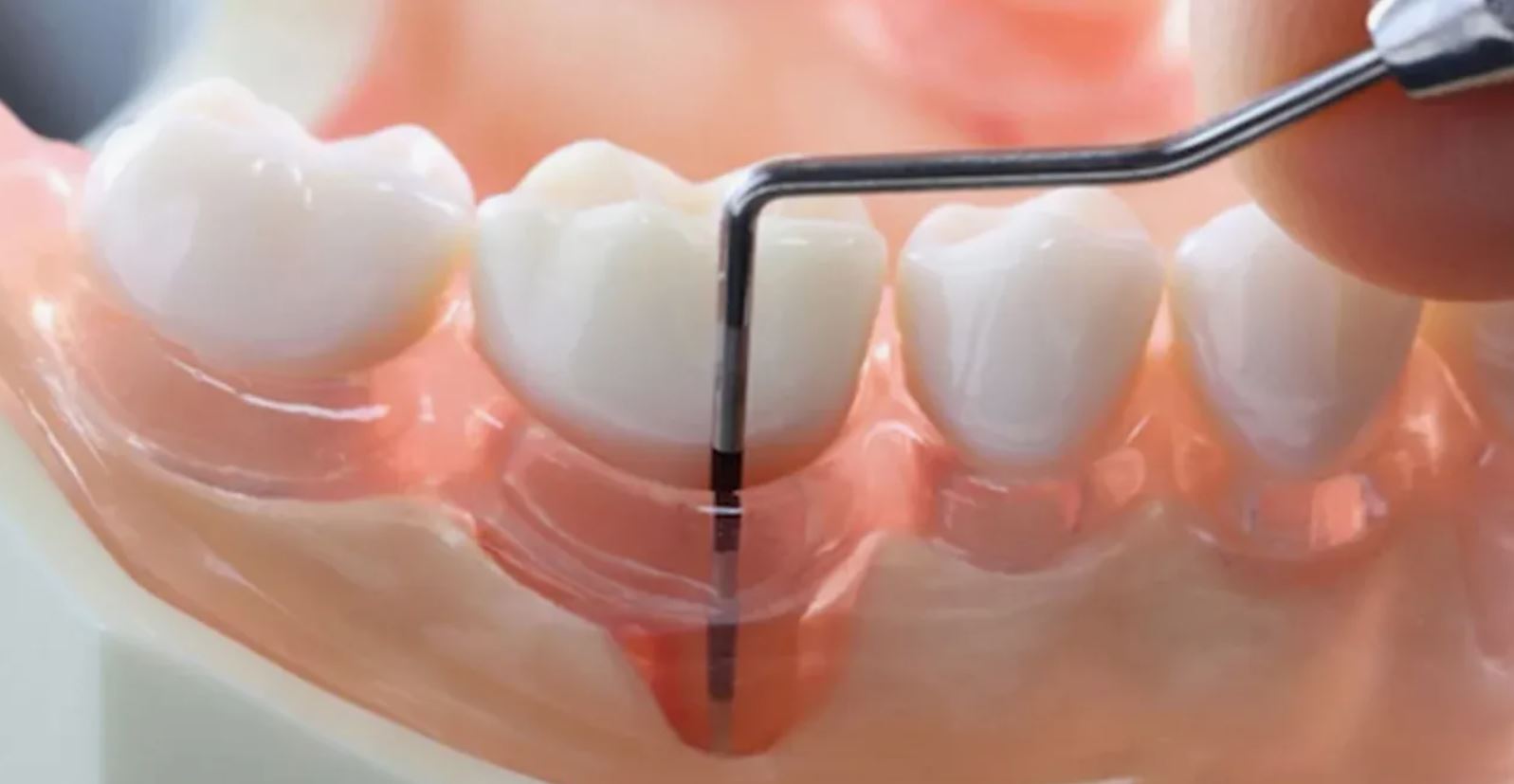 Лечение пародонтита