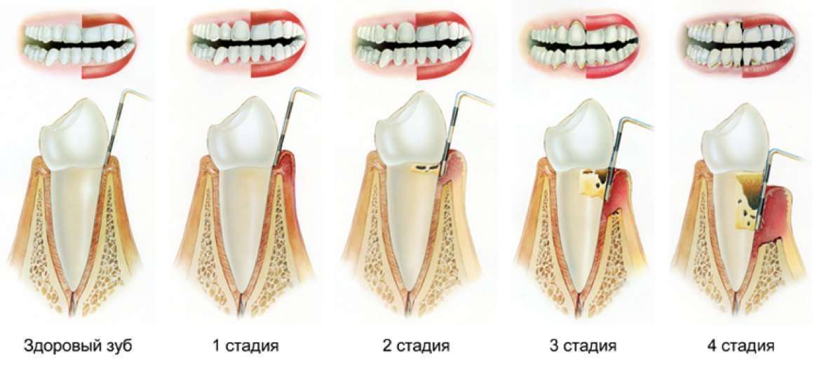 стадии пародонтоза
