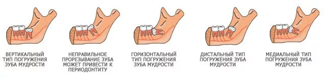 Типы зубов мудрости