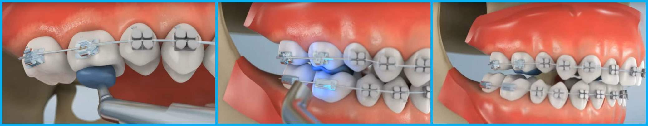 Исправления прикуса с помощью брекетов