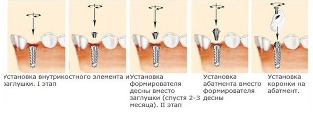 Установка формирователя десны