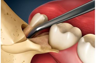 Сложное удаление зуба