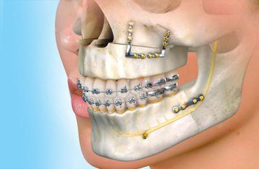Хирургическая коррекция прикуса