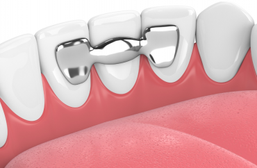 Микропротезирование зубов