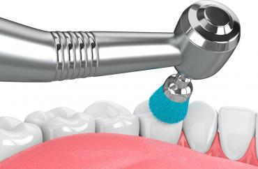 Чистка и полировка зубов