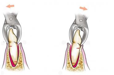 Удаление однокорневого зуба