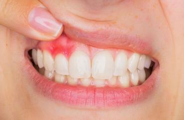 Лечение флюса