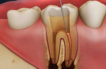 Лечение пульпита
