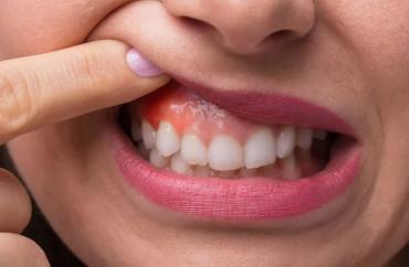 Лечение гингивита