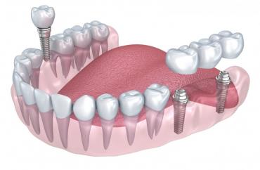 Имплантация нижних зубов