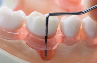 Лечение пародонтита