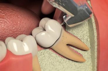 Удаление корня зуба