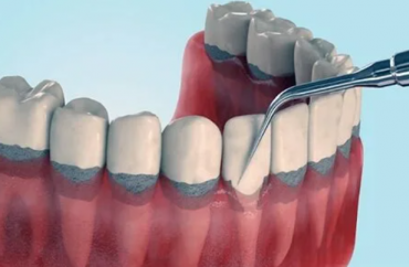 Кюретаж пародонтальных карманов 