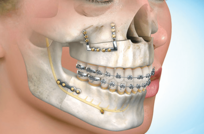 Исправление прикуса в г. Сыктывкаре
